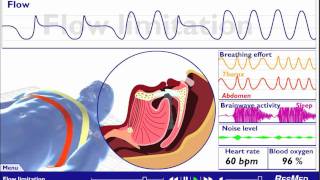 Understanding Sleep Disordered Breathing [upl. by Beverle150]