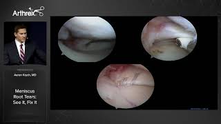 Meniscus Root Tears See It Fix It [upl. by Inva]