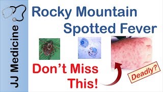 Rocky Mountain Spotted Fever  Bacteria Signs amp Symptoms Diagnosis and Treatment [upl. by Aliza]