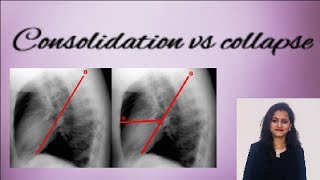 Chest X ray  How to differentiate consolidation from collapse [upl. by Redienhcs]