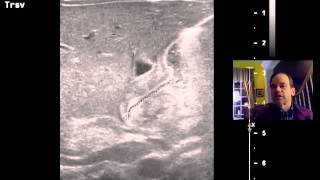 Infantile hypertrophic pyloric stenosis [upl. by Natsreik]