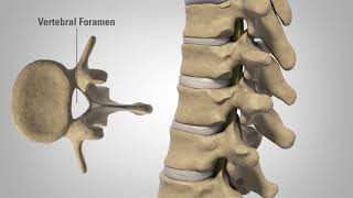 Myelopathy  Patient Education [upl. by Lecram488]