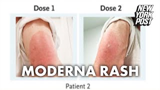 Side effect of Moderna vaccine may be a delayed skin rash doctors warn  New York Post [upl. by Oderfliw]