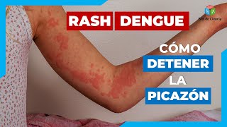 ▷ POR QUÉ OCURRE el SARPULLIDO EN EL DENGUE Y CÓMO CONTROLAR EFICAZMENTE [upl. by Arihaz]