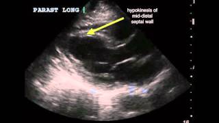 Apical ischemia [upl. by Analli]