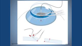 Astigmatism management after corneal transplantation  A State of Sight 44 [upl. by Yren]