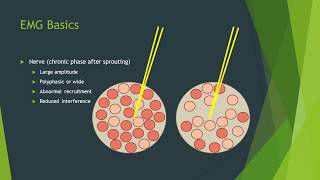 Myopathy EMG changes explained [upl. by Diao]