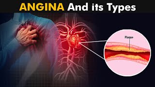 What is Angina And How it Works  Types Causes Symptoms and treatment 3D Animation [upl. by Mun565]