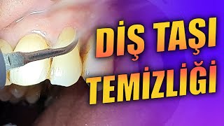 Diş Taşı Temizliği ve Kök Yüzeyi Düzleştirmesi [upl. by Ramah]