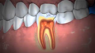 Treatment of Abscessed Teeth [upl. by Courtenay]