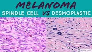 Spindle Cell vs Desmoplastic Melanoma Made Simple [upl. by Lirbij]