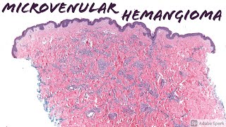 Microvenular Hemangioma 5Minute Pathology Pearls [upl. by Annwahs]