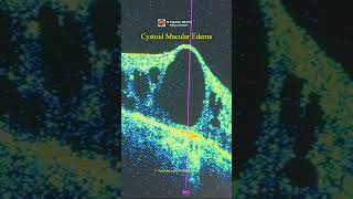 Atrophic AgeRelated Macular Degeneration [upl. by Daren]