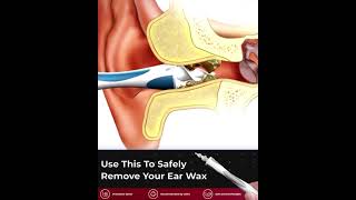 Tvidler The Safest way to remove earwax [upl. by Neille]