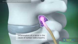 Lumbar Radiculopathy Reasons [upl. by Werna]