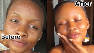 How I Truly Got Rid Of My Pimples In 2 Weeks  Clear Skin [upl. by Kleper398]