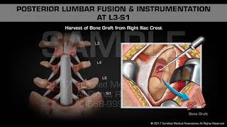 Posterior Lumbar Fusion amp Instrumentation at L3S1 [upl. by Pride279]