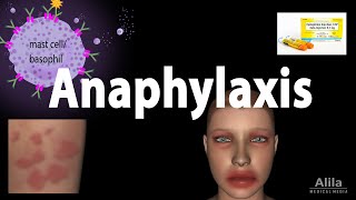 Anaphylaxis Animation [upl. by Leede109]