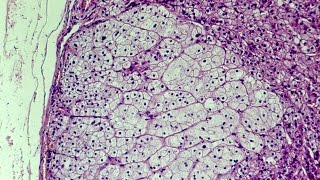 What is Hyperplasia  Pathology mini tutorial [upl. by Anomis]