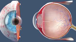 CATARACT Causes Signs and Symptoms Diagnosis and Treatment [upl. by Ekralc]