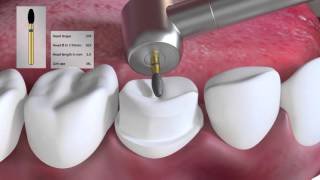 Crown preparation tutorial by Prof Brian Millar [upl. by Gnohc]