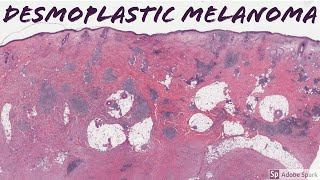 Desmoplastic Melanoma 5Minute Pathology Pearls [upl. by Therron]