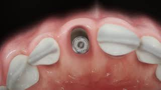 Straumann® BLX  Immediate anterior implant placement [upl. by Olin]