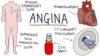 Understanding Angina Visual Explanation for Students [upl. by Irehj]