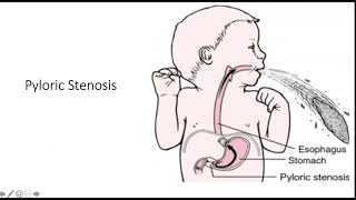 Hypertrophic Pyloric Stenosis [upl. by Apgar]