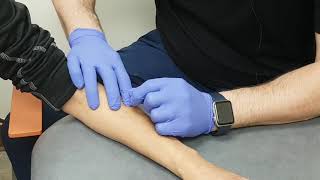 Dry Needling for Tennis Elbow [upl. by Sera]