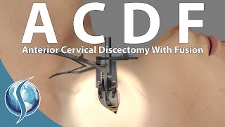 Anterior Cervical Discectomy and Fusion [upl. by Aonian]