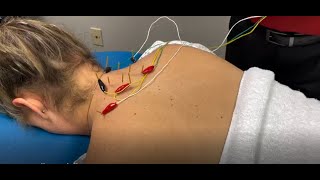 Dry Needling Demonstration and Explanation [upl. by Eeslek]