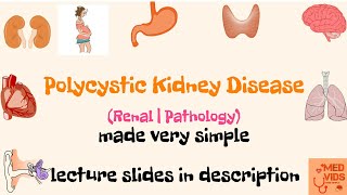 Polycystic Kidney Disease  Internal medicine by Dr Rajesh Gubba [upl. by Upton526]