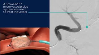 Discover Medtronics MVP™ micro vascular plug System and Concerto™ detachable coil system [upl. by Yborian]