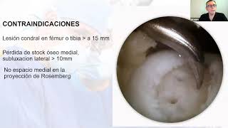 Webinar Osteotomía tibial alta [upl. by Akilat]