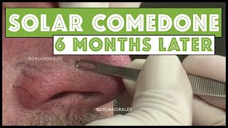 Blackheads  Solar Comedones extracted again 6 months later [upl. by Niatsirk74]