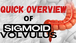 QUICK OVERVIEW of Sigmoid Volvulus [upl. by Hahsia]