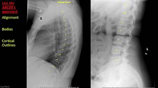 Introduction to Spine Radiographs [upl. by Nairot921]