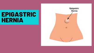 Epigastric hernia  symptoms clinical features [upl. by Nilre]