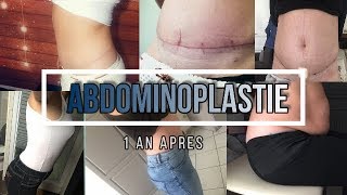 ABDOMINOPLASTIE 1 AN APRES [upl. by Dolloff]