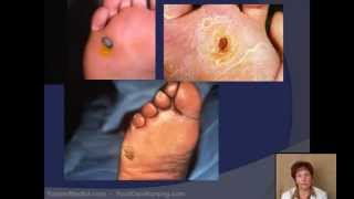 Corn amp Callus Debridement by a Podiatrist [upl. by Adamsun]