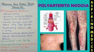 Polyarteritis nodosa pathology lectureVasculitis part 2 ASPIRING MEDICS [upl. by Kiah]