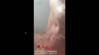 Jugular Venous Pulse Identification [upl. by Lyram16]