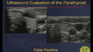 Ultrasound Evaluation of the Parathyroid [upl. by O'Toole]