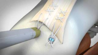 Achilles Tendon Repair  TACtite™ Knotless Suture Fixation System [upl. by Emaj266]