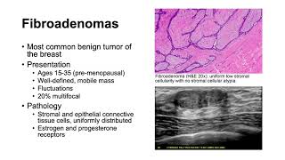 Fibroadenomas and Phyllodes Tumors [upl. by Yvehc88]