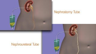 Removing my kidney stent at home [upl. by Burck]