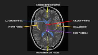 Imaging brain tumors  2  Astrocytomas [upl. by Kareem]