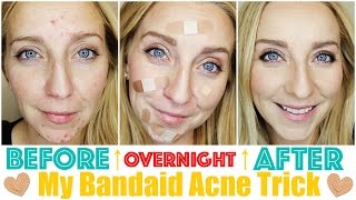 How to Get Rid of Acne Fast amp OVERNIGHT with My Bandaid Trick [upl. by Oicnedurp]