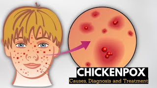 Chickenpox Causes Signs and Symptoms Diagnosis and Treatment [upl. by Kahcztiy]